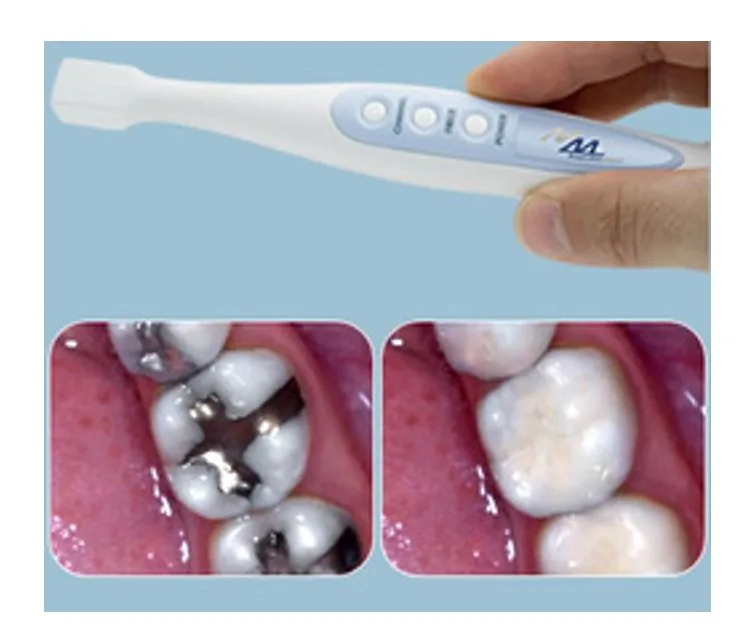 Intra-oral camera showing a tooth before and after treatment