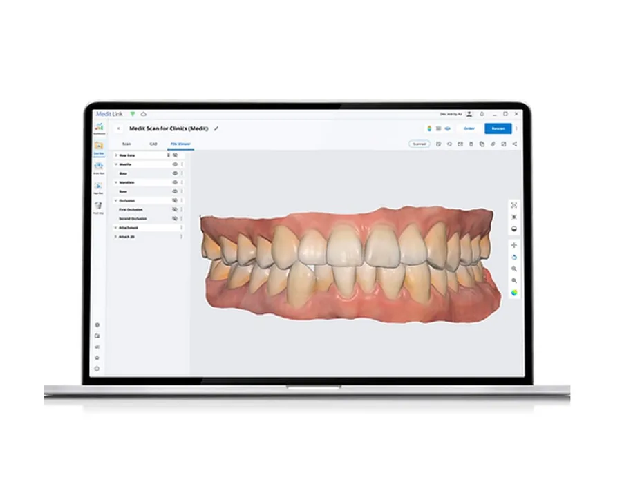 Digital 3D model of teeth on a laptop