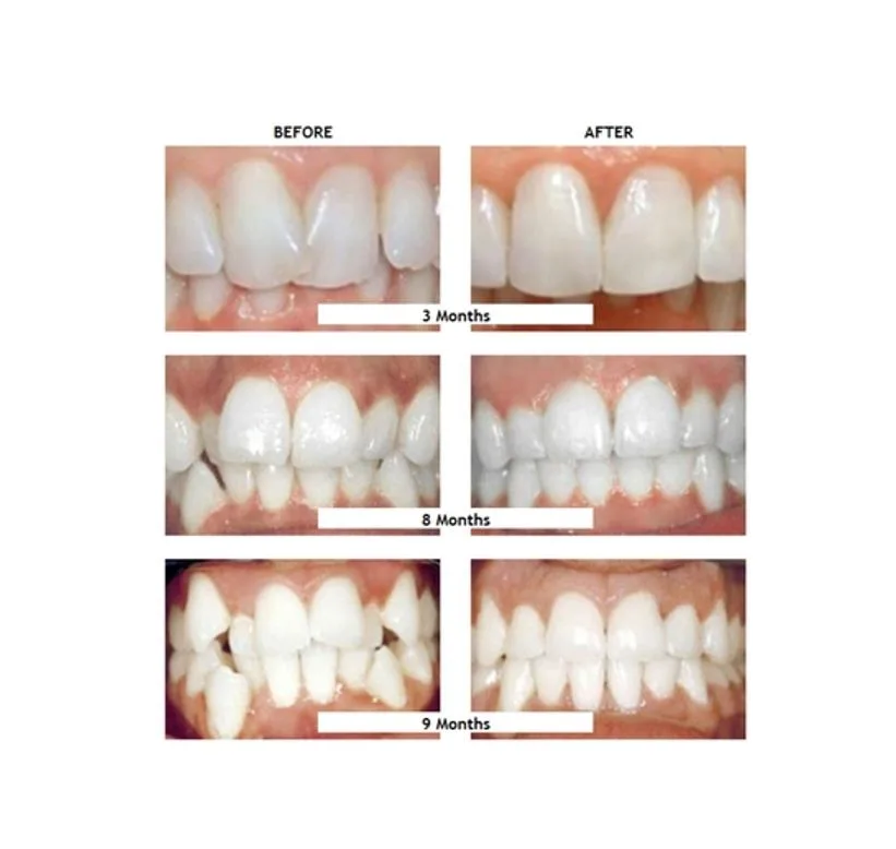 Before and after smile results at 3, 6 and 9 months